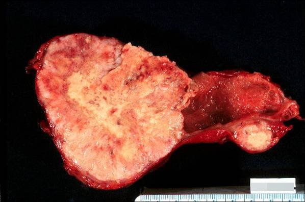 Cáncer de la Vesícula biliar - <div style=